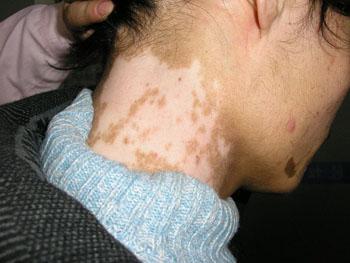 武汉白癫风治疗脸上长白斑是什么原因引起的