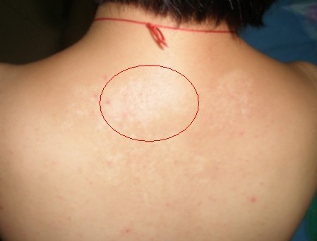 武汉有看白癜风的医院吗皮肤上有白块