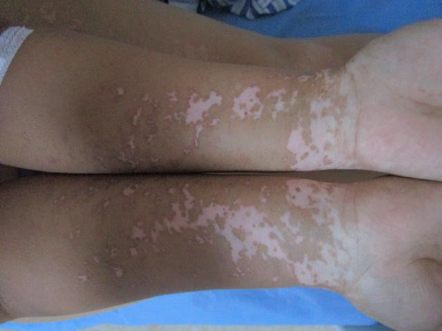 为什么肢端型白癜风恢复这么慢