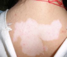 武汉检查白癜风要做什么哪些项目