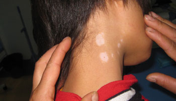 武汉白癜风治疗的原则