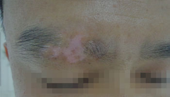 武汉白癜风究竟能治好吗 武汉白癜风究竟能治好吗