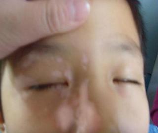 武汉白癜风疾病怎么治疗 武汉白癜风疾病怎么治疗