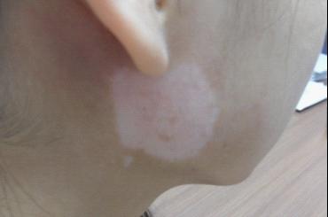 武汉白癜风的脸部症状有哪些?