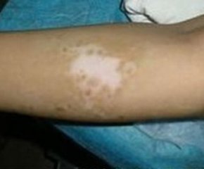 武汉白癜风初患该怎样治 武汉白癜风可以医治吗