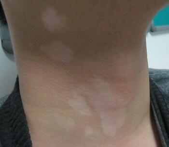 武汉白癜风早期该如何治愈 武汉白癜风早期该如何治愈