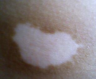 武汉的治疗方法有哪些呢 武汉的治疗方法有哪些呢