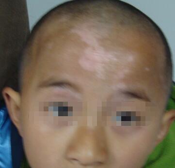 武汉儿童白癜风怎么治疗 武汉儿童白癜风怎么治疗