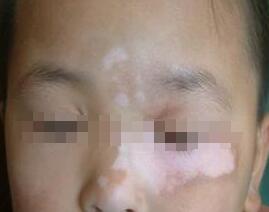 武汉小孩脸部白癜风危害 武汉小孩脸部白癜风危害