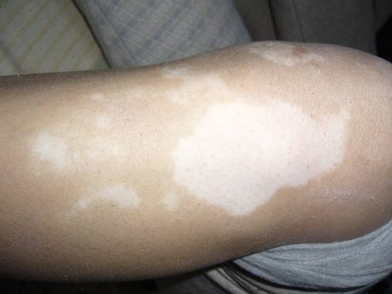 武汉儿童为什么会患有白癜风 武汉白癜风的病因是什么呢