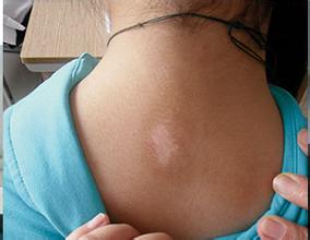 武汉白癜风的治疗需要注意什么呢 武汉白癜风的基本治疗方法