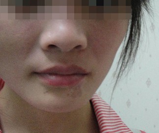 武汉儿童白癜风的治疗方法都有哪些呢 武汉白癜风初期治疗的注意有哪些呢