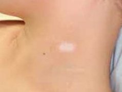 武汉儿童初期的白斑是什么样的 武汉儿童早期白癜风图片