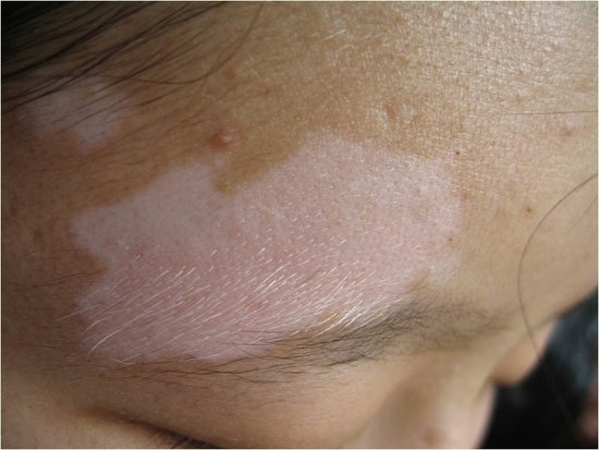 武汉女性白癜风治疗方法是什么 武汉女性患上白癜风该如何治疗