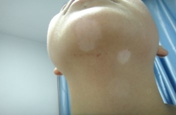 武汉女性白癜风怎么治疗最好 武汉女性有小块白斑需要治疗吗