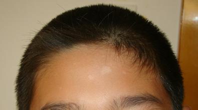 武汉青少年白癜风的早期症状 武汉孩子长了白斑怎么检查