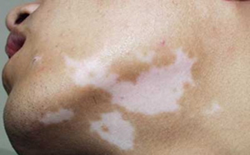 武汉青少年白癜风初期症状 武汉小孩身上出现白斑怎么来治疗