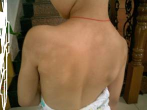 武汉青少年白癜风的初期症状有哪些 武汉青少年长白癜风什么原因