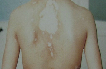 武汉白癜风鉴别诊断的有效措施 武汉白癜风鉴别诊断的有效措施