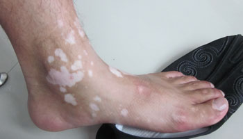 武汉白癜风的早期诊断具体怎么做 武汉怎样判断是否得了白癜风