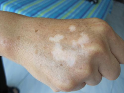 与正常皮肤不易区分,易被误诊为白色糠疹或汗斑等,应注意鉴别