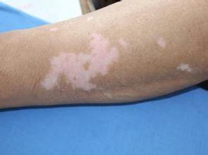 武汉小儿白癜风明显症状 武汉小儿白癜风明显症状