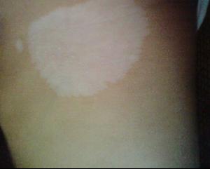 武汉青年白癜风明显症状是什么 武汉青年白癜风明显症状是什么