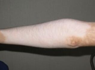 武汉儿童脸部白癜风危害大吗 武汉孩子白癜风症状危害