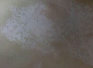 武汉白癜风有哪些诊断要点 武汉儿童白癜风诊断方法