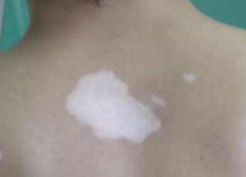 武汉诊断白癜风的注意事项早知道 武汉诊断白癜风的注意事项早知道