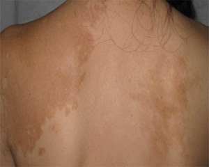 武汉激光能否用于治疗白癜风 武汉治疗白癜风有哪些方法呢