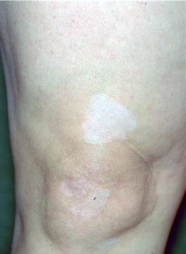 武汉白癜风能治愈吗 武汉白癜风能治愈吗