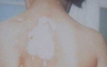 武汉白癜风预防有哪些措施 武汉白癜风预防和治疗