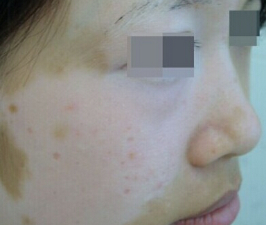 武汉最有效的治疗女性白癜风方法 武汉女性在患上白癜风后怎么治疗好