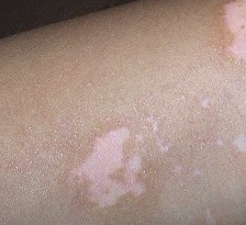 武汉治疗白癜风会不会很复杂 武汉治疗白癜风会不会很复杂