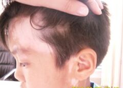 武汉治疗白癜风哪家比较好 武汉治疗白癜风哪家比较好