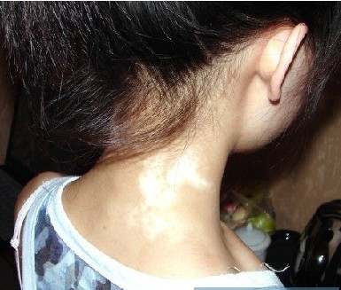 武汉白癜风治疗要多久才能好 武汉白癜风该选择怎么治疗方案