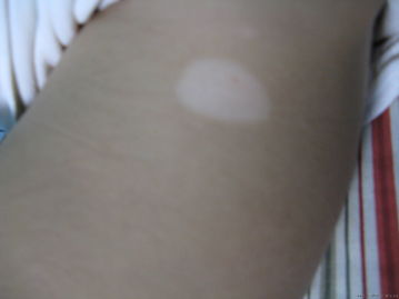 武汉治疗白癜风要用多长时间 武汉治疗白癜风要用多长时间