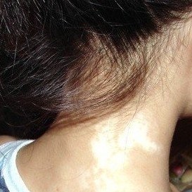 武汉白癜风的各种类型有什么症状 武汉白癜风病发图片什么样