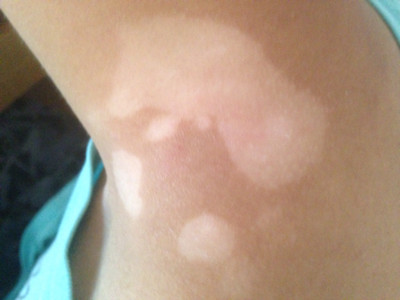 武汉白癜风初期表现形式什么样的 武汉白癜风的防治需要做什么