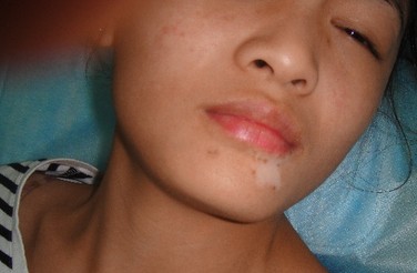 武汉白癜风病发什么样 武汉什么是白癜风的病发症状呢