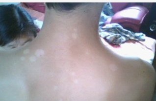 武汉请问专家白癜风能治疗吗? 武汉患上白癜风能治疗好吗