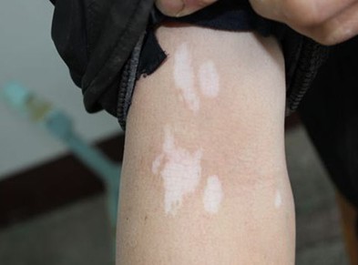 武汉儿童患白癜风该如何治疗 武汉请问白癜风能不能治好呢