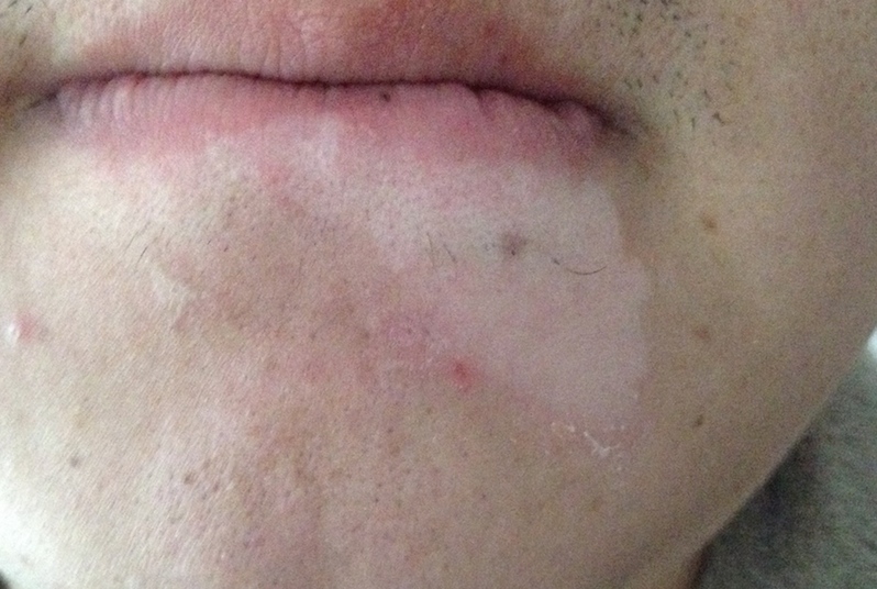 武汉中期白癜风一般需要治疗多久 武汉白癜风什么手段能够治疗好