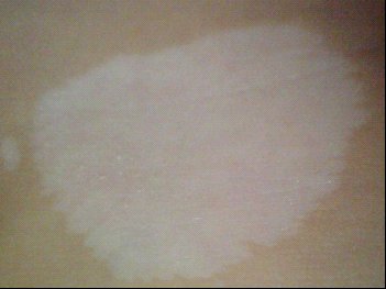 武汉手上生了白癜风不治疗会扩散吗 武汉白癜风的治疗需要多少钱