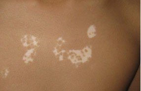 武汉夏季白癜风应该怎么治疗好呢 武汉长了白癜风得怎么做