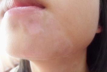 武汉一般治疗白癜风使用什么方法 武汉白癜风长在女性脸上要怎么办