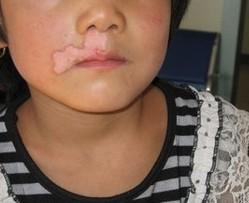 武汉白癜风的治疗有哪些地方需要注意 武汉治疗儿童白癜风时该怎么做