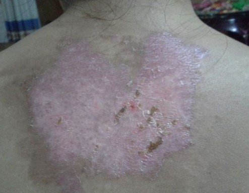 武汉治白巅环亚出彩 武汉看白环亚出