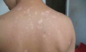 武汉治白斑特临环亚 武汉治疗白殿环亚礼